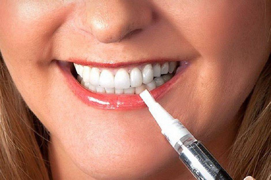 Виды отбеливания зубов – плюсы и минусы