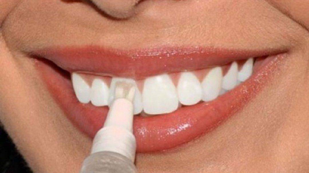 На сколько тонов можно отбелить зубы? ответ стоматолога